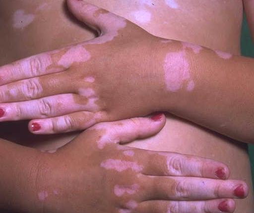 vitiligo.JPG