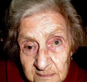 unequal pupil size and visual disturbances unequal pupil size and visual disturbances