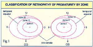 Figure 1 - Classification of Retinopathy of Prematurity by zone