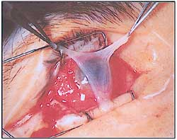 Amniotic membrane transplantation in ophthalmology