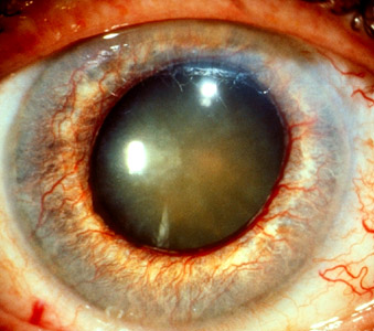 Rubeosis iridis or neovascularization of the iris in diabetes