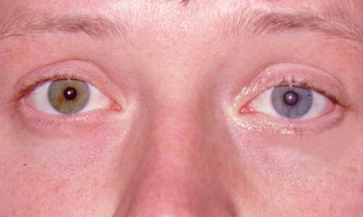 Heterochromia iridis