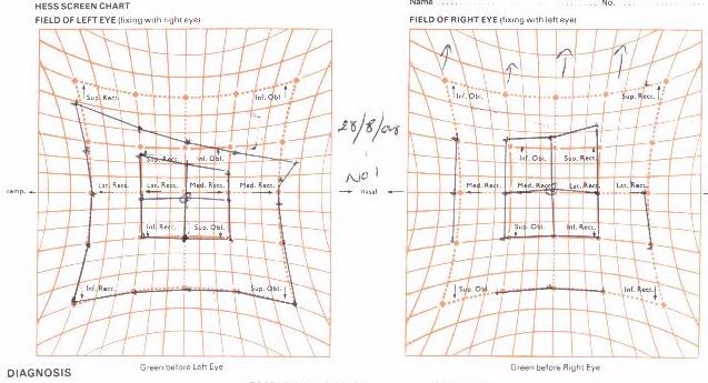 Diplopia Charting