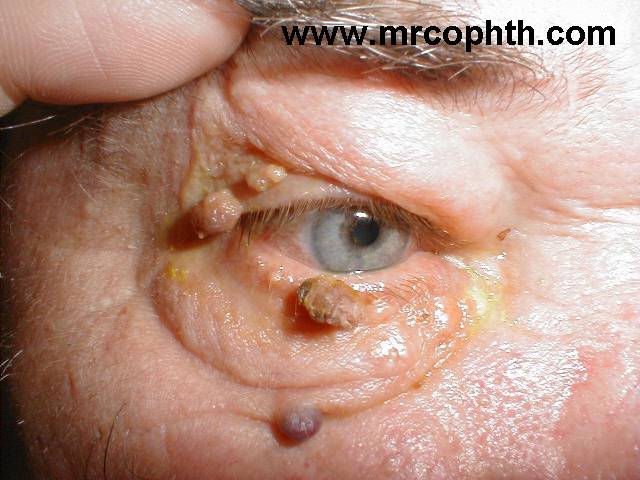 papilloma eyelid causes