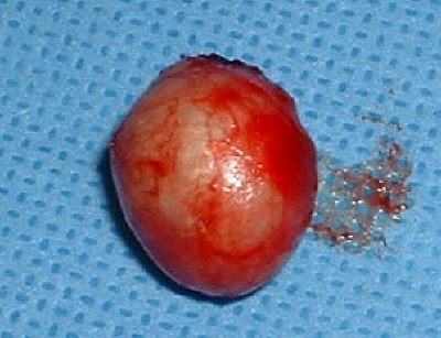 Cysts With Hair And Teeth. 1. sebaceous cyst
