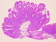 Conjunctival squamous papilloma histopathology