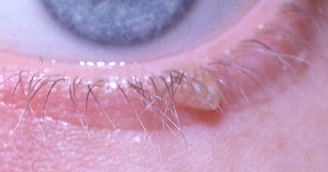 papilloma eyelid