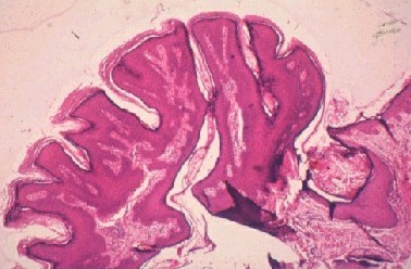 conjunctival papilloma pathology
