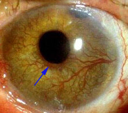 Rubeosis iridis or neovascularization of the iris in diabetes