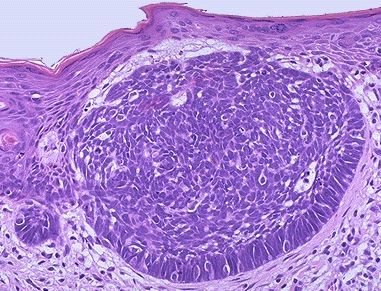 Superficial Basal Cell Carcinoma Histology