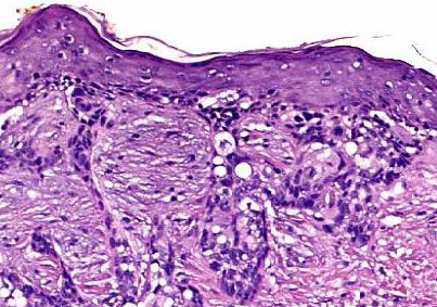 Basal Cell Carcinoma Eyelid Histology