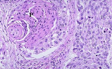 Basal cell carcinoma: biology, morphology and clinical ...